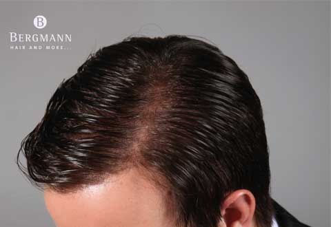 wigs-hair-prosthesis-new-age-bergmann-kord- hair-clinics-home-page-carousel-complete-coverage-001