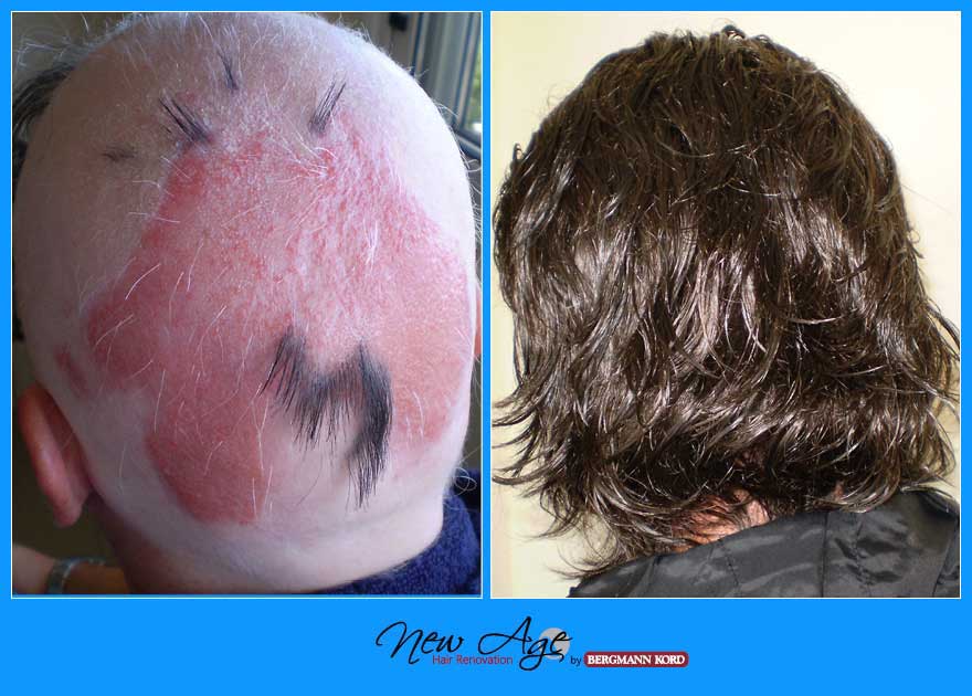 wigs-hair-prosthesis-new-age-bergmann-kord-hair-clinics-results-medical-cases-before-after-010001PG-001