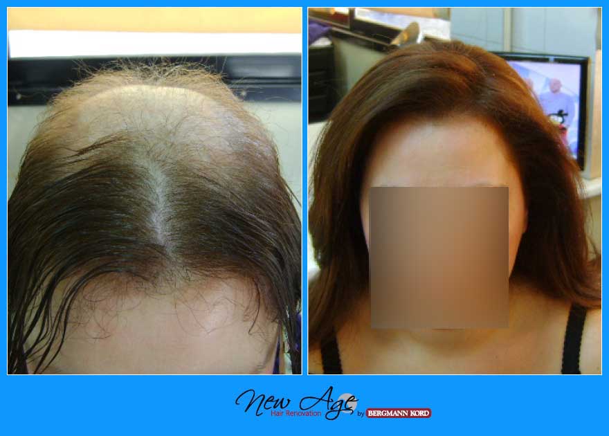 wigs-hair-prosthesis-new-age-bergmann-kord-hair-clinics-results-medical-cases-before-after-010022PG-001