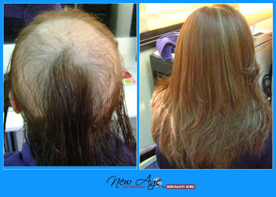 wigs-hair-prosthesis-new-age-bergmann-kord-hair-clinics-results-medical-cases-before-after-010022PG-002