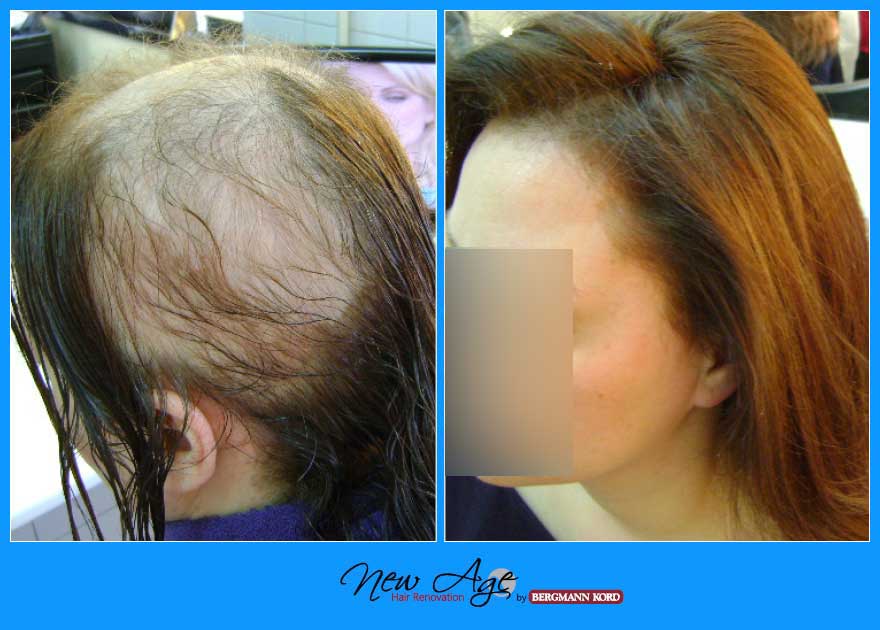 wigs-hair-prosthesis-new-age-bergmann-kord-hair-clinics-results-medical-cases-before-after-010022PG-003