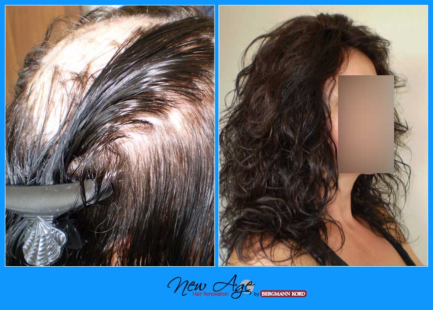 wigs-hair-prosthesis-new-age-bergmann-kord-hair-clinics-results-medical-cases-before-after-010033PG-001