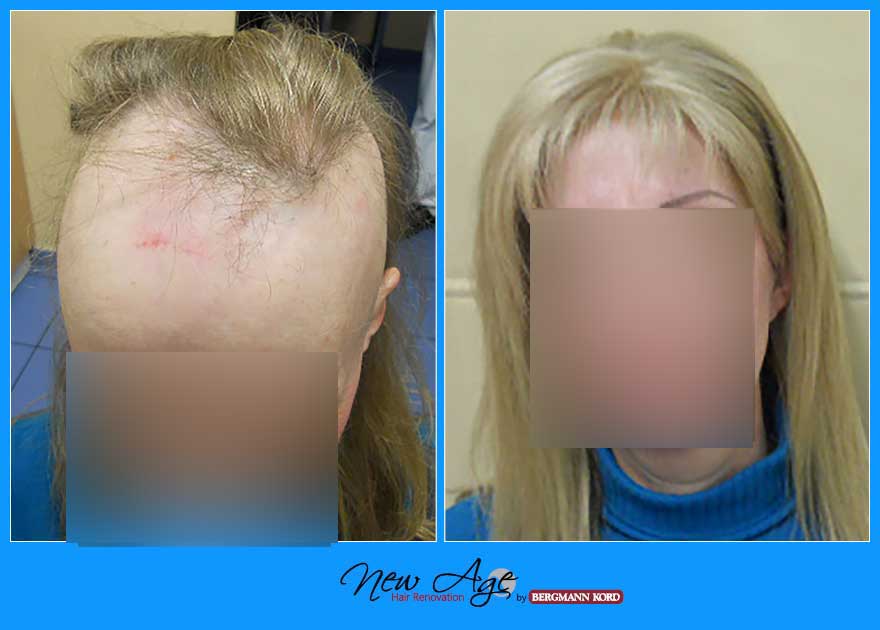 wigs-hair-prosthesis-new-age-bergmann-kord-hair-clinics-results-medical-cases-before-after-013760PG-001
