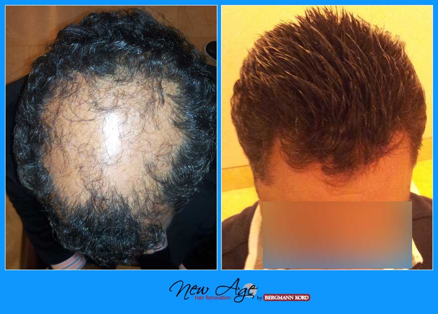 wigs-hair-prosthesis-new-age-bergmann-kord-hair-clinics-results-medical-cases-before-after-023101PG-001
