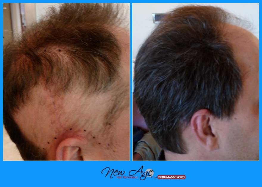 wigs-hair-prosthesis-new-age-bergmann-kord-hair-clinics-results-medical-cases-before-after-023740PG-001