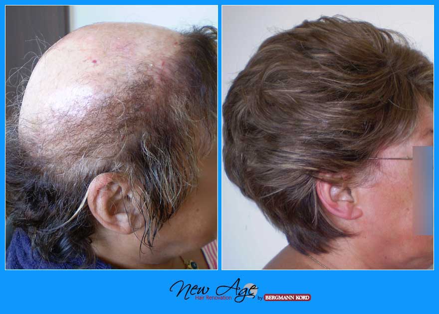 wigs-hair-prosthesis-new-age-bergmann-kord-hair-clinics-results-medical-cases-before-after-055999PG-001