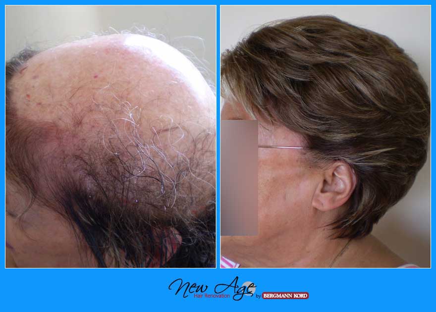 wigs-hair-prosthesis-new-age-bergmann-kord-hair-clinics-results-medical-cases-before-after-055999PG-002