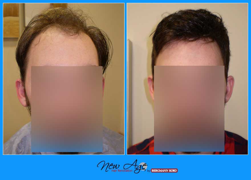 wigs-hair-prosthesis-new-age-bergmann-kord-hair-clinics-results-men-before-after-010090PG-001