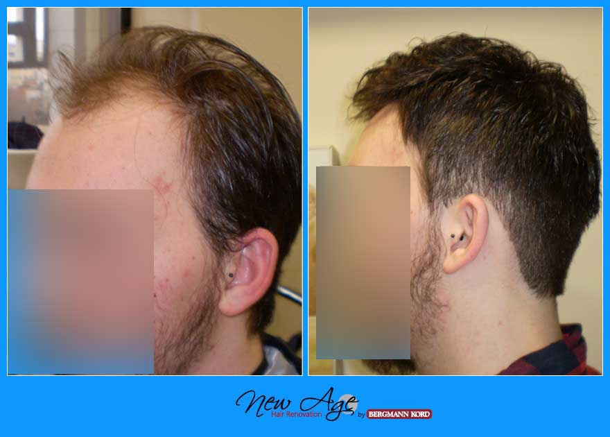 wigs-hair-prosthesis-new-age-bergmann-kord-hair-clinics-results-men-before-after-010090PG-002