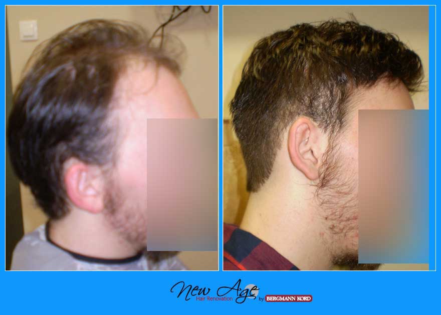 wigs-hair-prosthesis-new-age-bergmann-kord-hair-clinics-results-men-before-after-010090PG-003