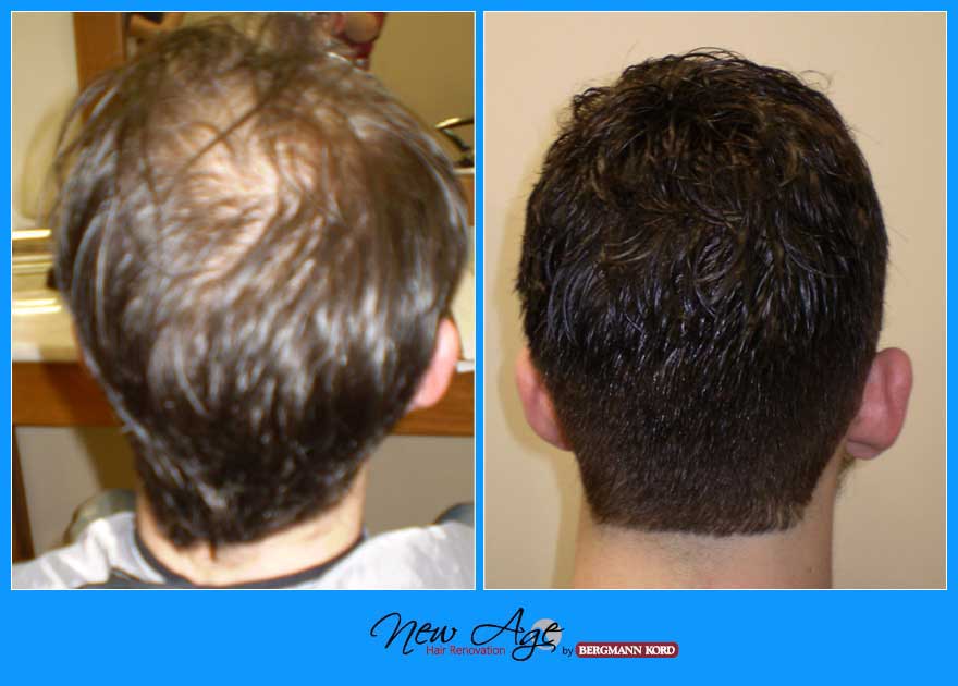 wigs-hair-prosthesis-new-age-bergmann-kord-hair-clinics-results-men-before-after-010090PG-004