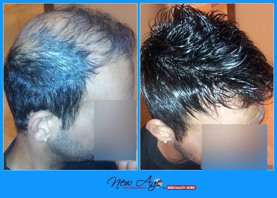 wigs-hair-prosthesis-new-age-bergmann-kord-hair-clinics-results-men-before-after-010396PG-001