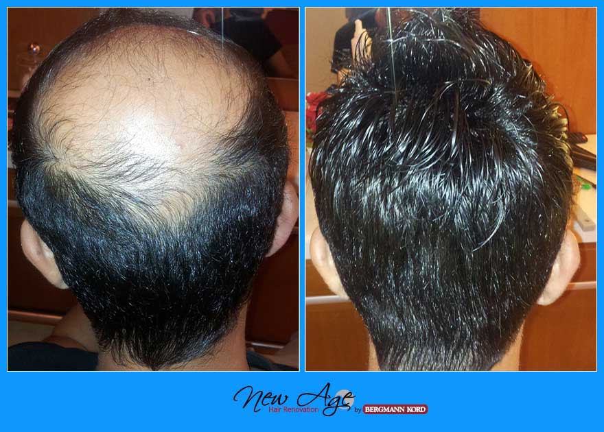 wigs-hair-prosthesis-new-age-bergmann-kord-hair-clinics-results-men-before-after-010396PG-002