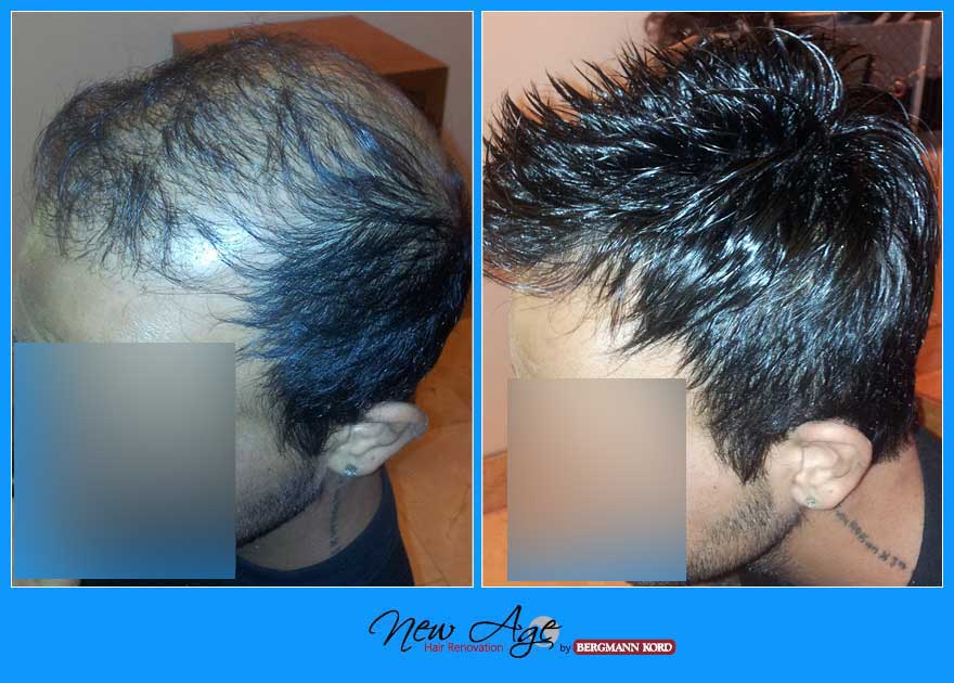 wigs-hair-prosthesis-new-age-bergmann-kord-hair-clinics-results-men-before-after-010396PG-003