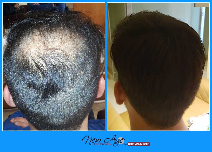 wigs-hair-prosthesis-new-age-bergmann-kord-hair-clinics-results-men-before-after-012321PG-002