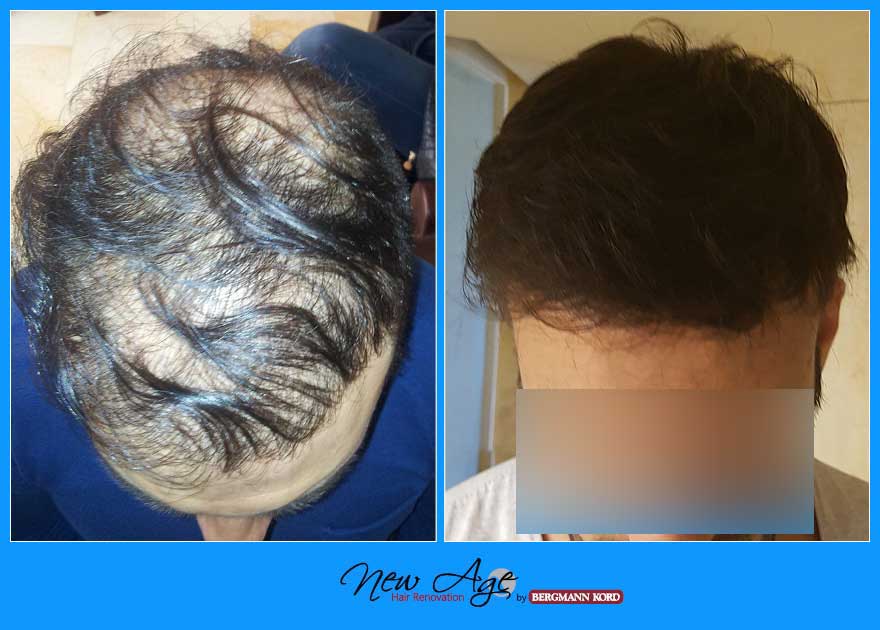 wigs-hair-prosthesis-new-age-bergmann-kord-hair-clinics-results-men-before-after-012321PG-004