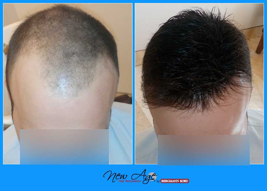 wigs-hair-prosthesis-new-age-bergmann-kord-hair-clinics-results-men-before-after-012567PG-001