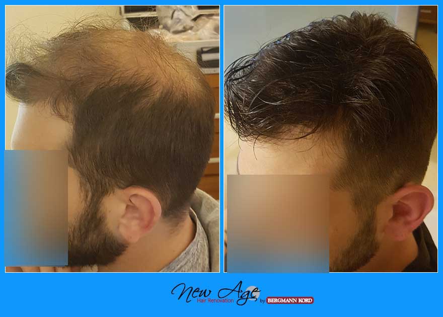 wigs-hair-prosthesis-new-age-bergmann-kord-hair-clinics-results-men-before-after-017908PG-001