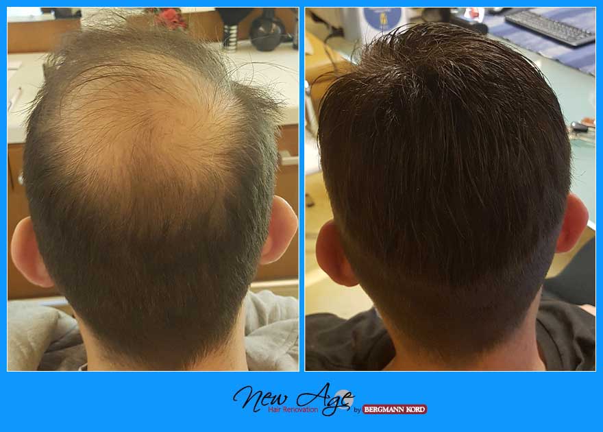 wigs-hair-prosthesis-new-age-bergmann-kord-hair-clinics-results-men-before-after-017908PG-002
