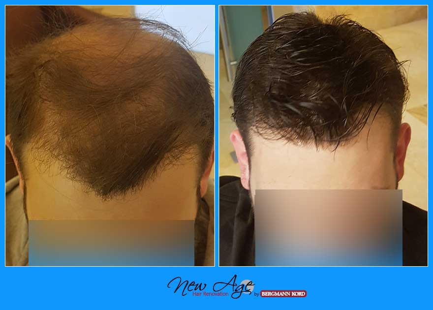 wigs-hair-prosthesis-new-age-bergmann-kord-hair-clinics-results-men-before-after-017908PG-003