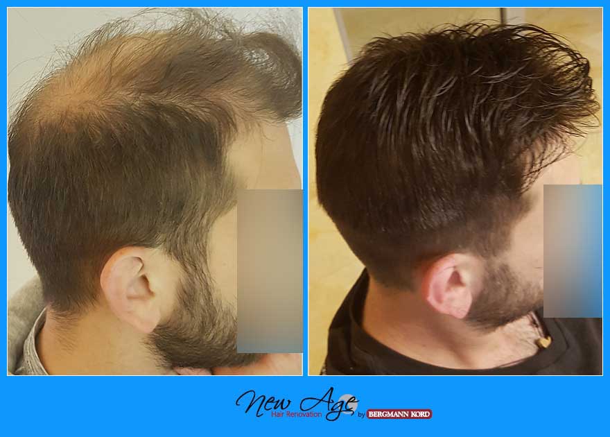 wigs-hair-prosthesis-new-age-bergmann-kord-hair-clinics-results-men-before-after-017908PG-004