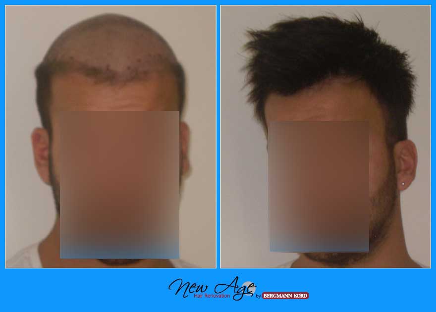 wigs-hair-prosthesis-new-age-bergmann-kord-hair-clinics-results-men-before-after-021001PG-001