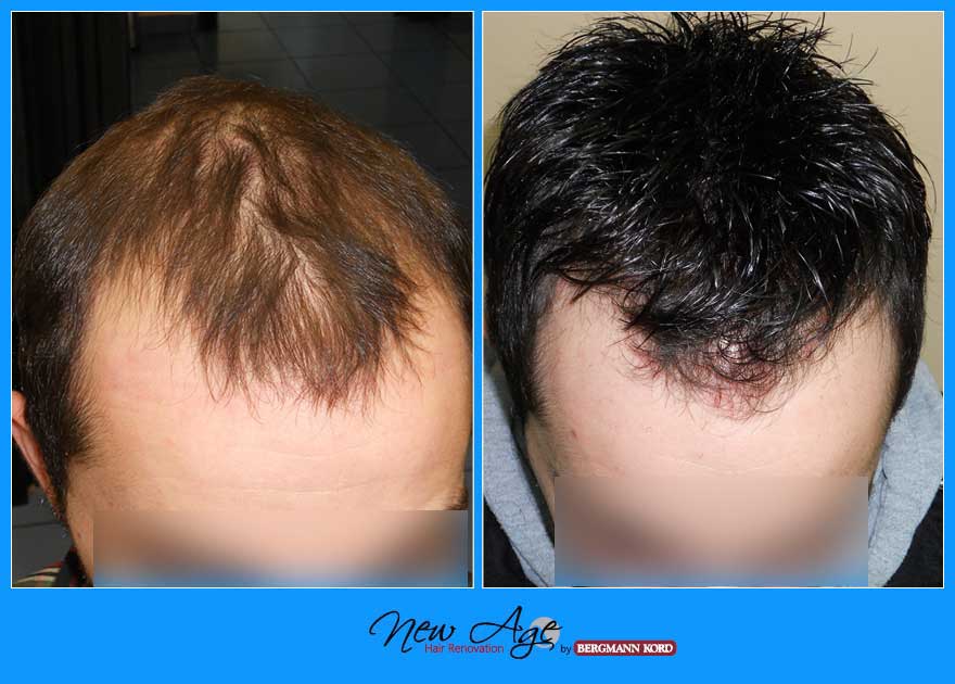 wigs-hair-prosthesis-new-age-bergmann-kord-hair-clinics-results-men-before-after-021908PG-001