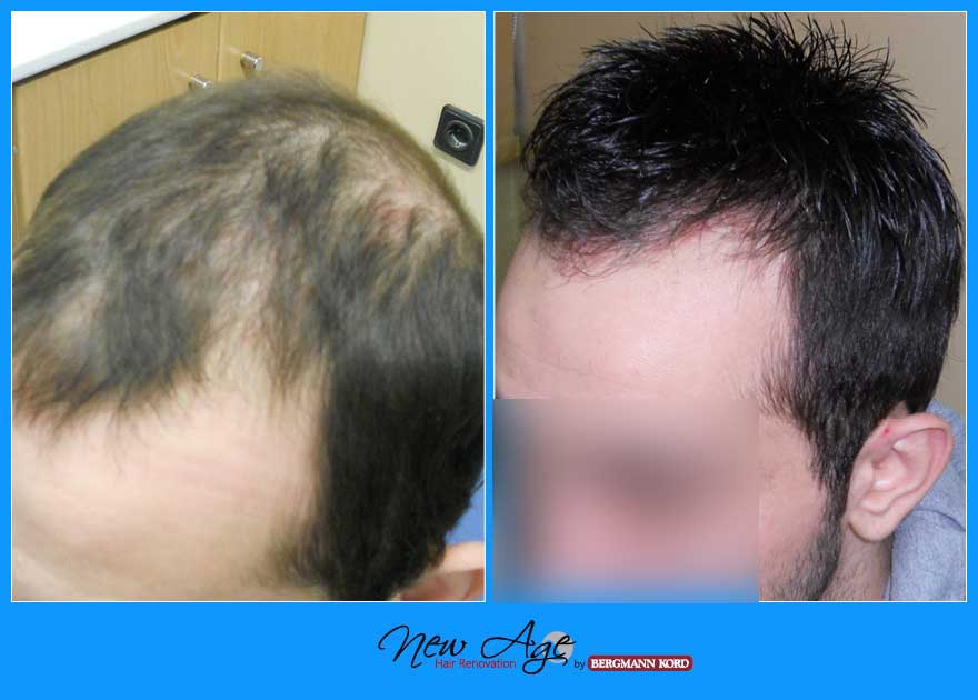 wigs-hair-prosthesis-new-age-bergmann-kord-hair-clinics-results-men-before-after-021908PG-002