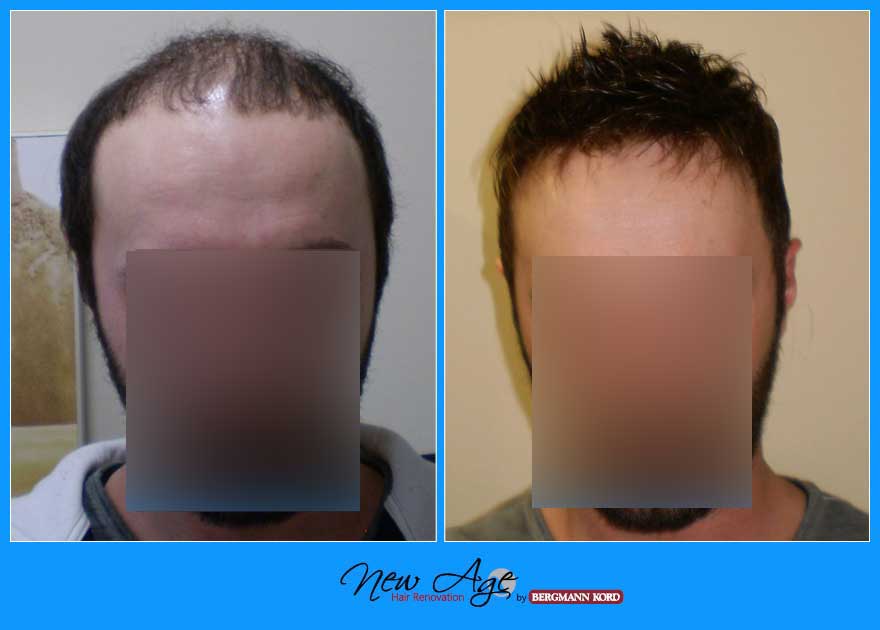 wigs-hair-prosthesis-new-age-bergmann-kord-hair-clinics-results-men-before-after-022245PG-001