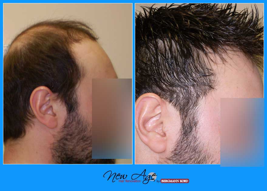 wigs-hair-prosthesis-new-age-bergmann-kord-hair-clinics-results-men-before-after-022245PG-003