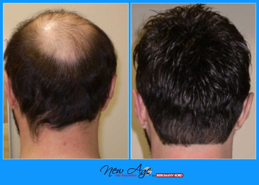 wigs-hair-prosthesis-new-age-bergmann-kord-hair-clinics-results-men-before-after-022245PG-004
