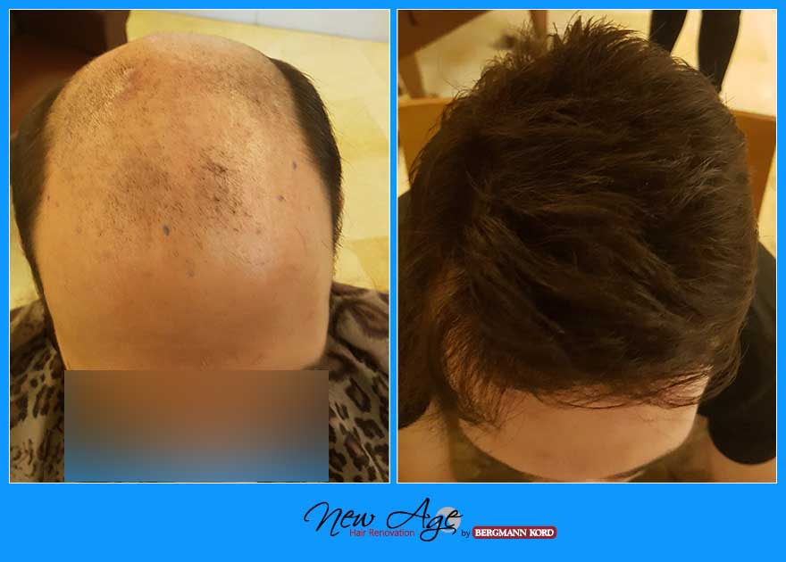 wigs-hair-prosthesis-new-age-bergmann-kord-hair-clinics-results-men-before-after-022780PG-001