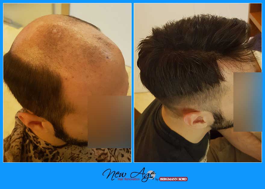 wigs-hair-prosthesis-new-age-bergmann-kord-hair-clinics-results-men-before-after-022780PG-002
