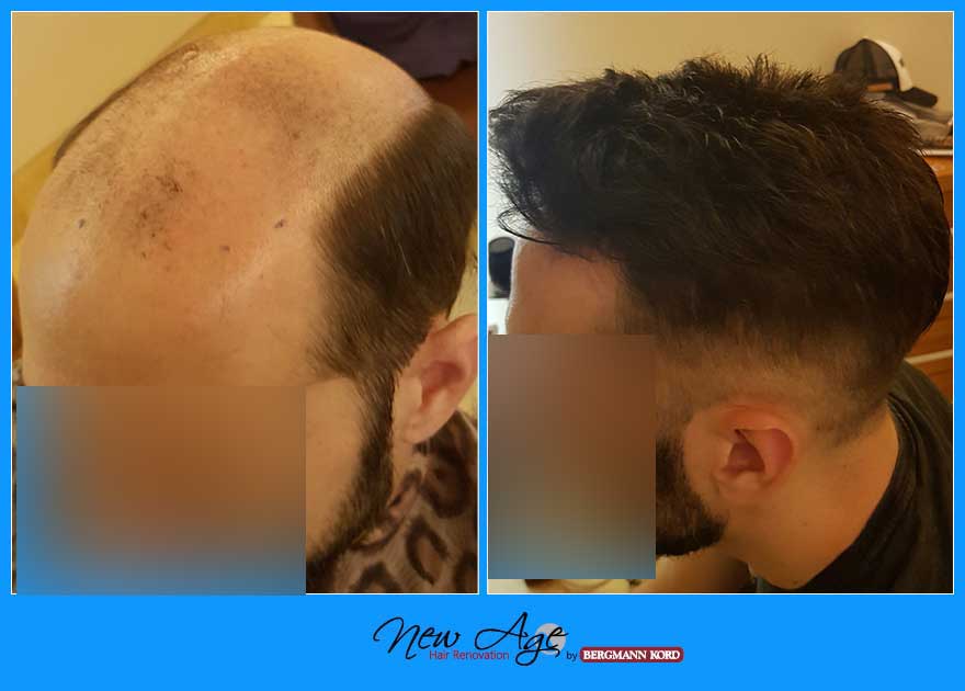 wigs-hair-prosthesis-new-age-bergmann-kord-hair-clinics-results-men-before-after-022780PG-003