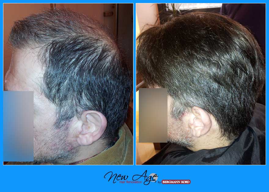 wigs-hair-prosthesis-new-age-bergmann-kord-hair-clinics-results-men-before-after-022900PG-001