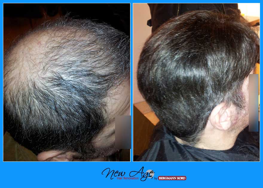 wigs-hair-prosthesis-new-age-bergmann-kord-hair-clinics-results-men-before-after-022900PG-002