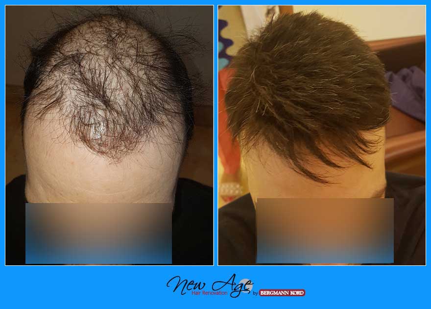 wigs-hair-prosthesis-new-age-bergmann-kord-hair-clinics-results-men-before-after-023245PG-001