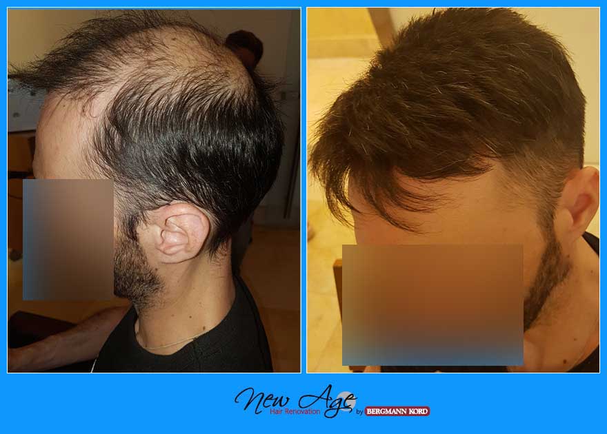 wigs-hair-prosthesis-new-age-bergmann-kord-hair-clinics-results-men-before-after-023245PG-002