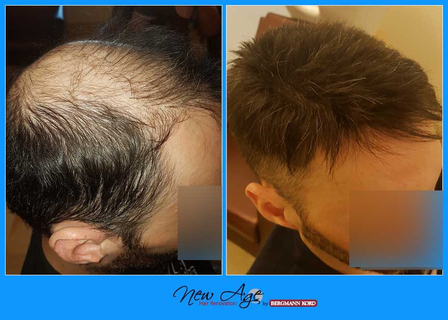 wigs-hair-prosthesis-new-age-bergmann-kord-hair-clinics-results-men-before-after-023245PG-004