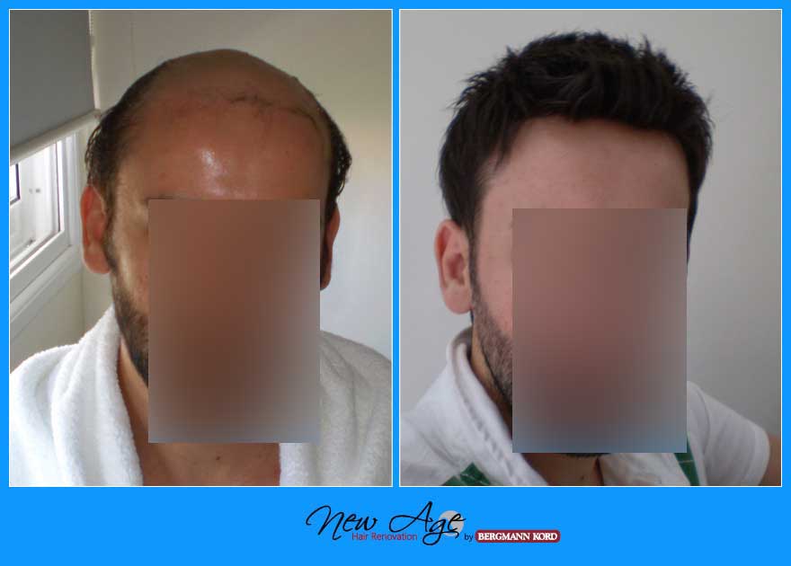 wigs-hair-prosthesis-new-age-bergmann-kord-hair-clinics-results-men-before-after-024678PG-001