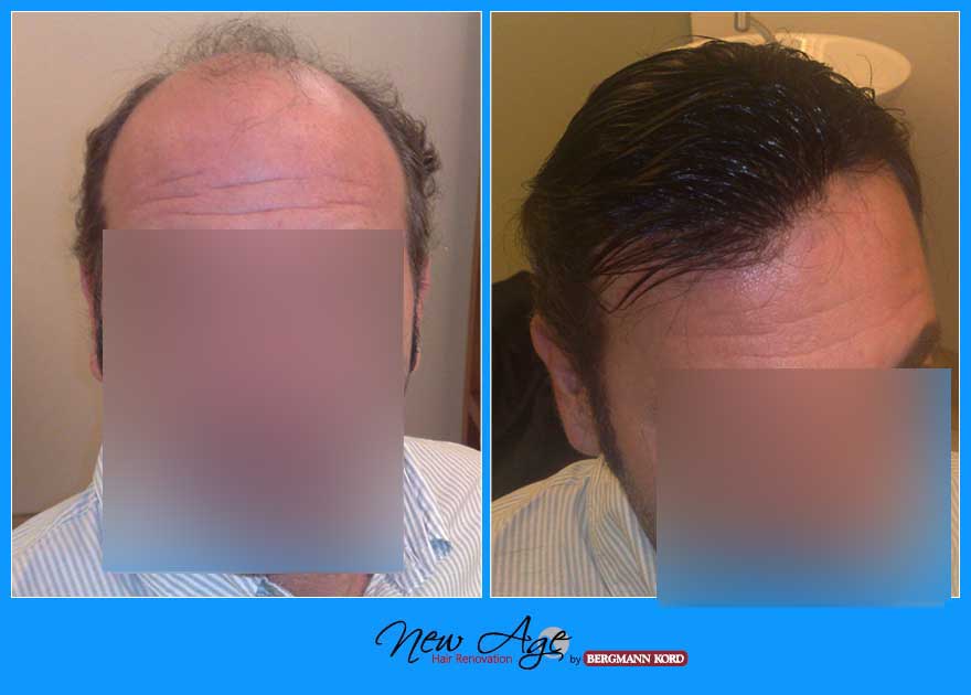 wigs-hair-prosthesis-new-age-bergmann-kord-hair-clinics-results-men-before-after-029876PG-001