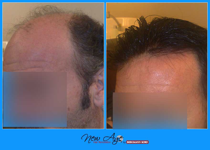 wigs-hair-prosthesis-new-age-bergmann-kord-hair-clinics-results-men-before-after-029876PG-002