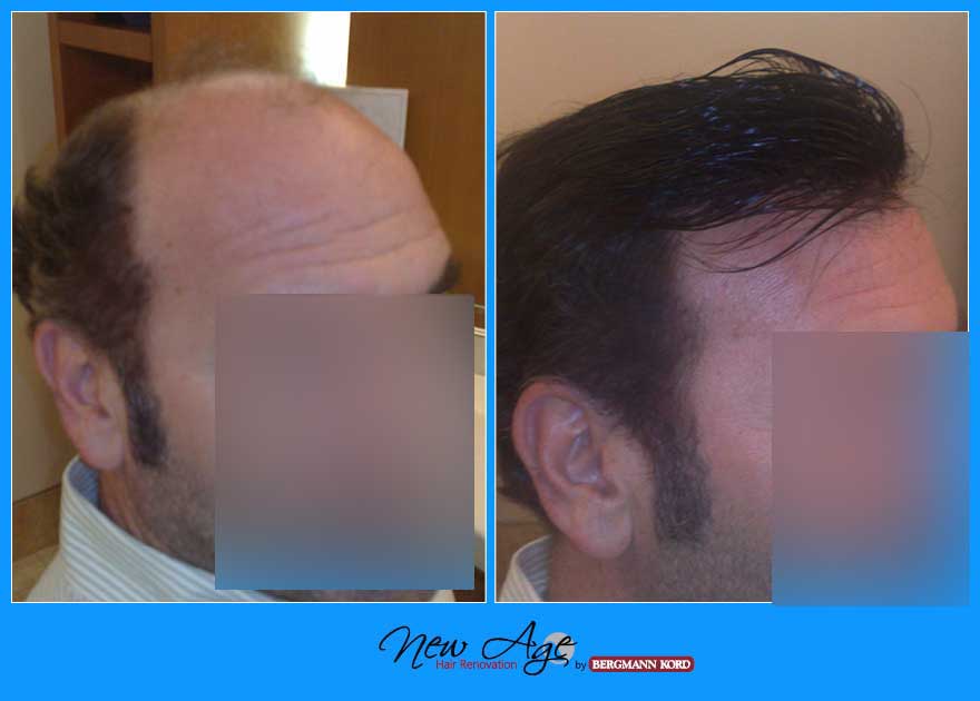 wigs-hair-prosthesis-new-age-bergmann-kord-hair-clinics-results-men-before-after-029876PG-003