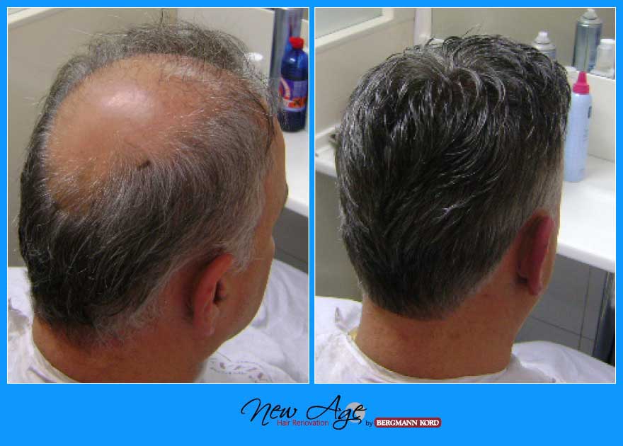 wigs-hair-prosthesis-new-age-bergmann-kord-hair-clinics-results-men-before-after-030096PG-001