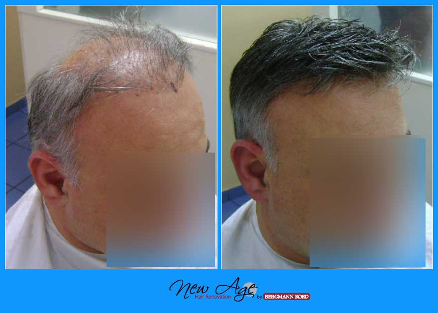 wigs-hair-prosthesis-new-age-bergmann-kord-hair-clinics-results-men-before-after-030096PG-002