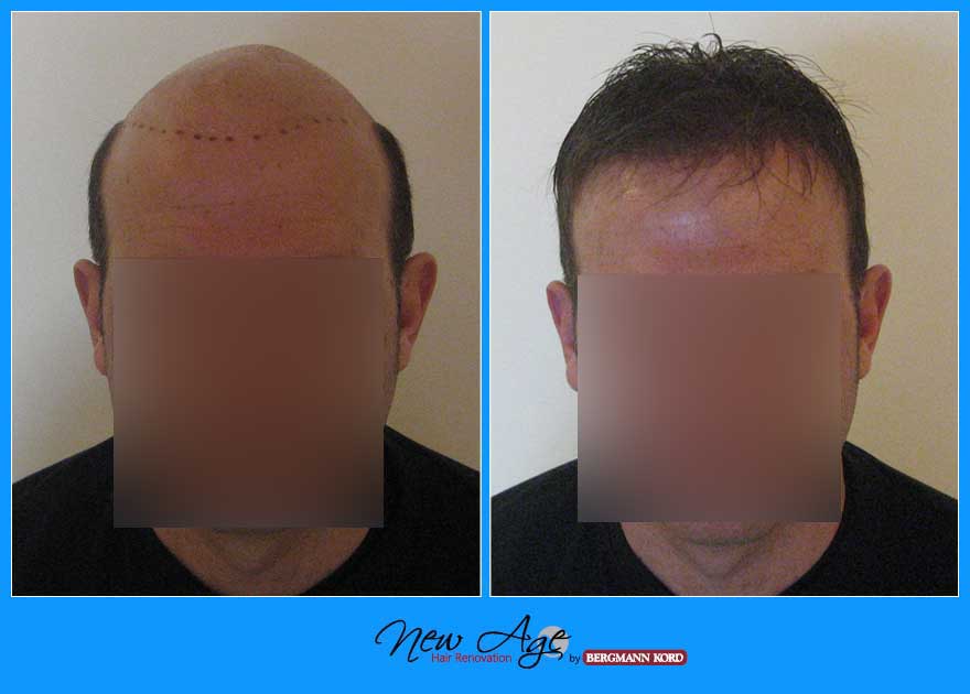 wigs-hair-prosthesis-new-age-bergmann-kord-hair-clinics-results-men-before-after-031039PG-001