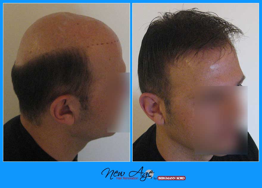 wigs-hair-prosthesis-new-age-bergmann-kord-hair-clinics-results-men-before-after-031039PG-002