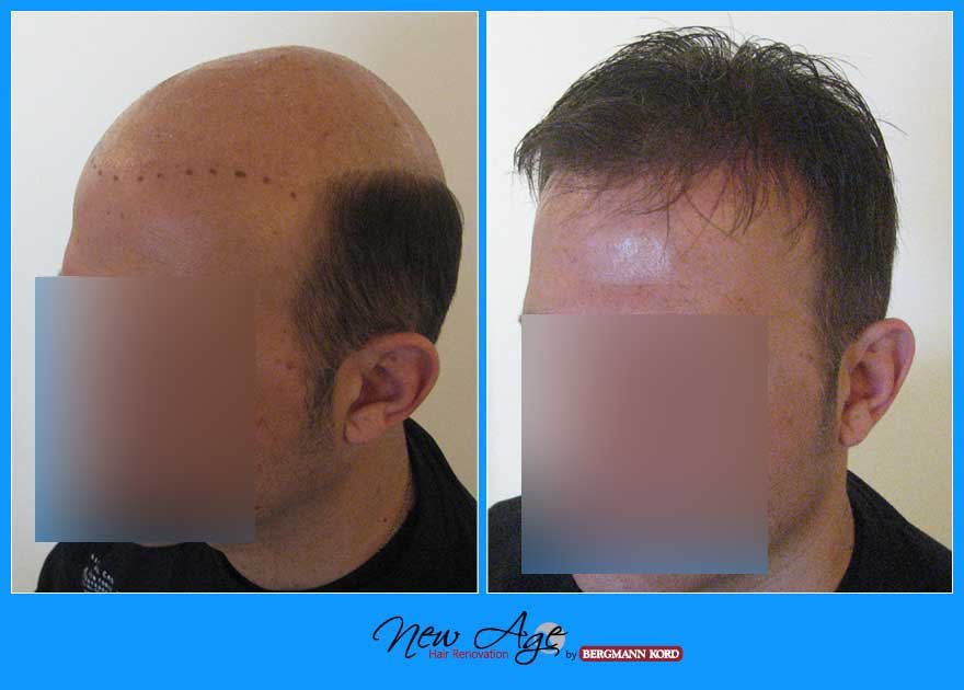 wigs-hair-prosthesis-new-age-bergmann-kord-hair-clinics-results-men-before-after-031039PG-003
