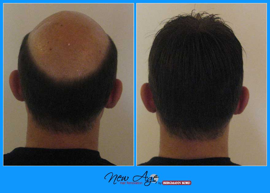 wigs-hair-prosthesis-new-age-bergmann-kord-hair-clinics-results-men-before-after-031039PG-004