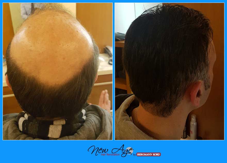 wigs-hair-prosthesis-new-age-bergmann-kord-hair-clinics-results-men-before-after-035670PG-001